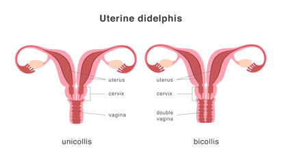 Didelphis human uterus structure of unicollis and bicollis types. Uterine deep septum as a congenital uterine malformation. Anatomy chart.
