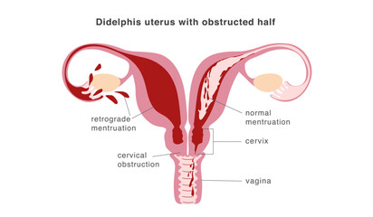 Congenital malformation of uterus isolating part of organ and causing retrograde menstruation as possible reason of endometriosis.