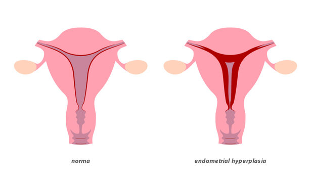 Endometrial hyperplasia in uterus medical illustration. Precancerous condition of female endometrium.