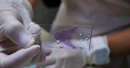 A gloved hand holds a stained blood smear. In the laboratory, a doctor holds a glass with a blood...