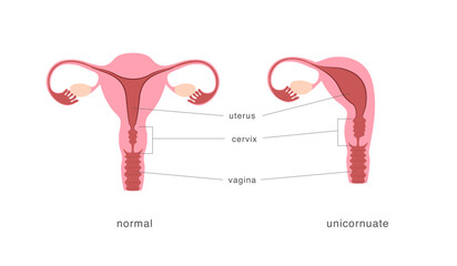 Unicornuate and normal healthy uterus comparison chart. Congenital malformation of female reproductive system.