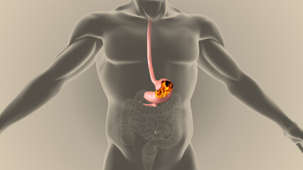Gerd acidity stomach reflux heartburn ache - obrazy, fototapety, plakaty