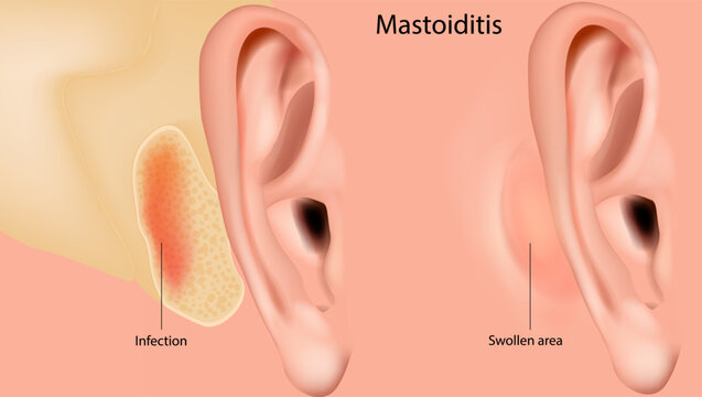 Mastoiditis. Inflammation of the mucosal lining of the mastoid antrum and mastoid air cell system inside the mastoid process. Medical illustration