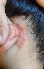 Seborrheic dermatitis or fungal skin infection behind the ear of Asian patient