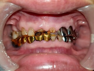 Metal crowns in mouth of Asian man. Poor oral hygiene