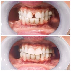 Before and after fixation for huge gap between front teeth or incisors, diastema.