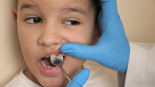 The doctor examines the oral cavity of a child with a missing tooth using a dental mirror. Healthcare and dental care concept.