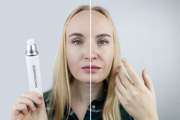 Vitamin A, Retinol, Niacinamide, Vitamin C. Girl smears her face with antioxidant anti-wrinkle cream. Anti-aging and facial rejuvenation agent. Before and after. Visual result. Acne treatment