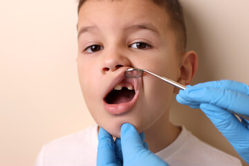 The doctor examines the oral cavity of a child with a missing tooth using a dental mirror....