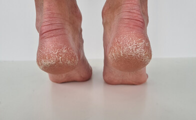 Two legs with scaly and cracked heels