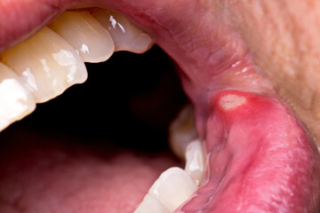 4K Ultra HD Close-Up Image of Tongue with Canker Sores - Oral Health Awareness