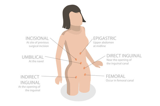 3D Isometric Flat  Illustration of Type Of Abdominal Hernias, Inguinal Hernia