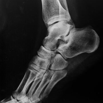 Detalle de la radiograf&iacute;a de un pie humano en blanco y negro