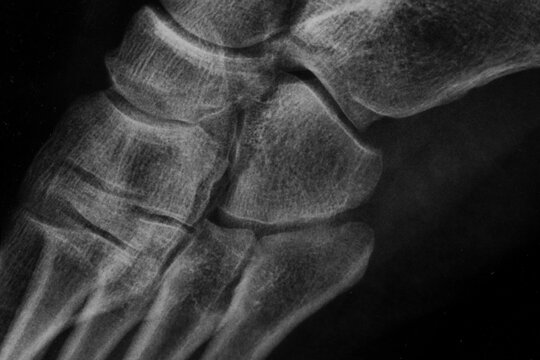 Detalle de la radiograf&iacute;a de un pie humano en blanco y negro