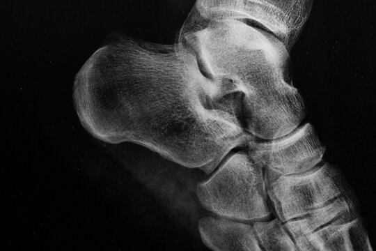 Detalle de la radiograf&iacute;a de un pie humano en blanco y negro