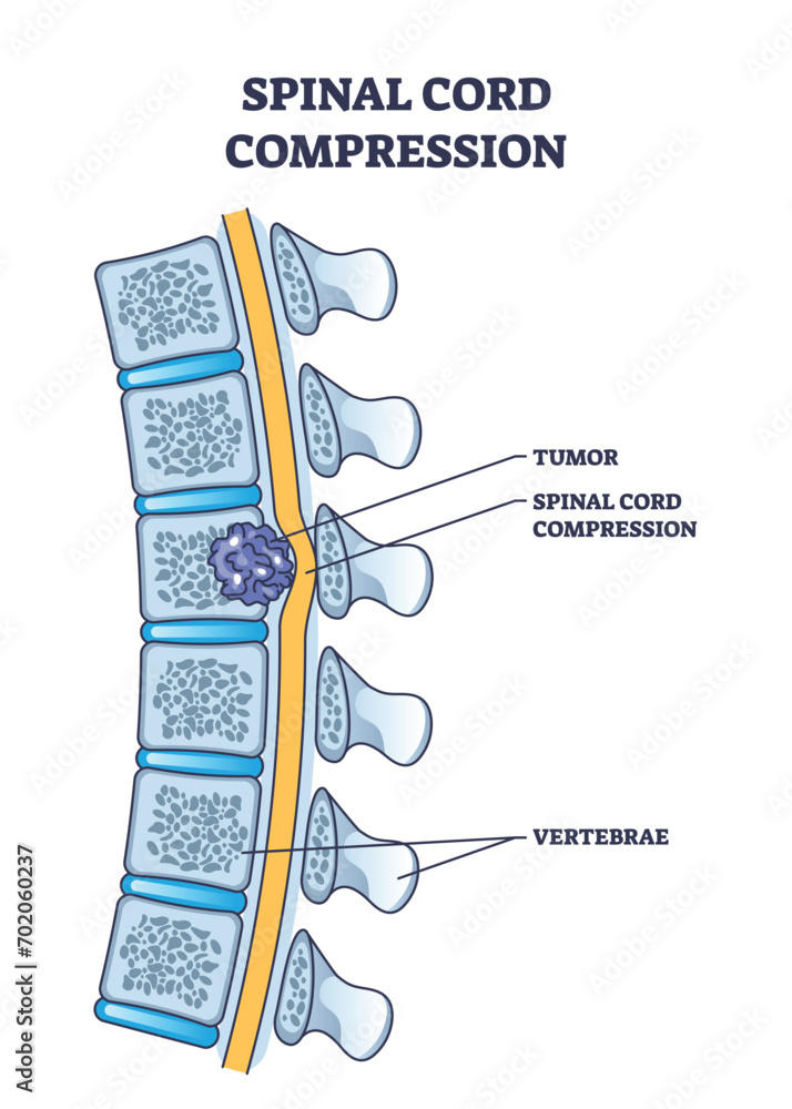 Poster spinal cord compression with tumor and vertebrae condition outline diagram. painful back cause with 