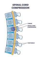 Spinal cord compression with tumor and vertebrae condition outline diagram. Painful back cause with medical problem explanation vector illustration. Skeleton pathology and unhealthy skeletal position - obrazy, fototapety, plakaty