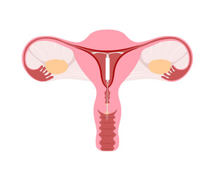 Intrauterine device with hormone capsule inside the uterus. Hormonal IUD for women contraception. - obrazy, fototapety, plakaty