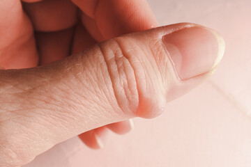 Hygroma (Ganglion cyst) of the thumb joint. Selective focus.
