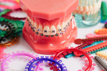 Orthodontic ligatures rings and ties, elastic rubber bands on orthodontic braces, model for dentist...