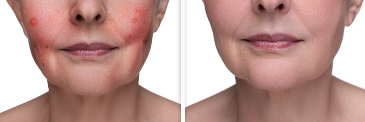 Before and after rosacea treatment. Photos of woman on white background, closeup. Collage showing affected and healthy skin - obrazy, fototapety, plakaty