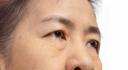 The ptosis or droopy eyelids in asian senior woman.. - obrazy, fototapety, plakaty