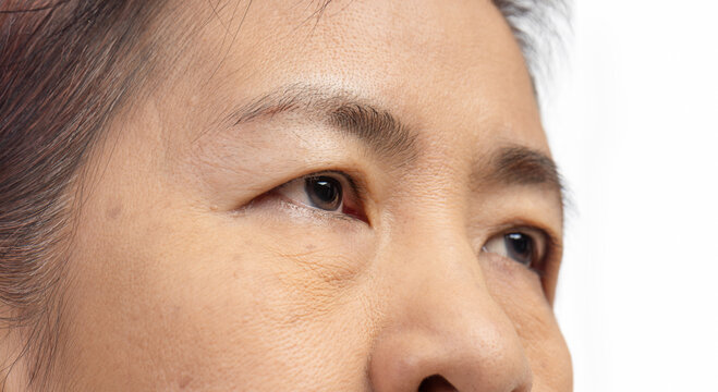 The ptosis or droopy eyelids in asian senior woman..
