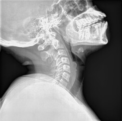 Normal film xray or radiograph of a cervical neck. Lateral extension view which is the best way to...