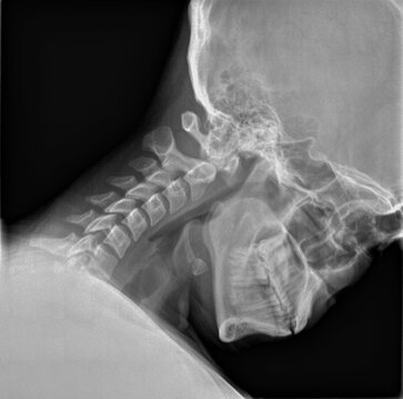 Normal film xray or radiograph of a cervical neck. Lateral flexion view which is the best way to see Spondylolisthesis and to assess for spinal and ligament stability particularly after an injury