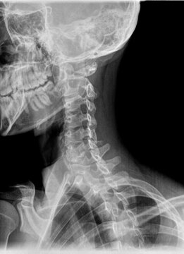 Normal film xray or radiograph of a cervical neck. Lateral slightly oblique view to see if any fracture of the pars inarticularis is present