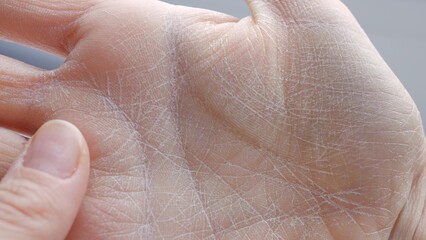 Dry skin on palm close-up side view peeling skin on palm lack of moisture dermatitis cosmetology and dermatology healthcare and medicine hand care, concept of problematic dry skin on palms of hands