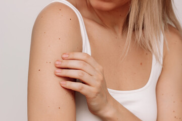Cropped shot of a young blonde woman with a large number of moles on her arms isolated on a white...