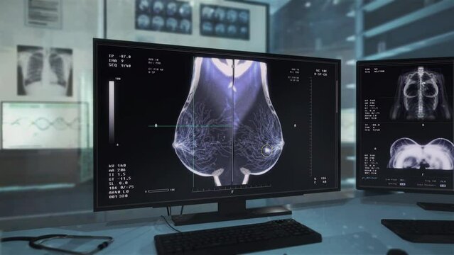 Breast cancer diagnostic procedure at the modern healthcare clinic. Diagnostic equipment searches for the breast cancer cells in the female chest. Diagnostic system detects breast cancer.