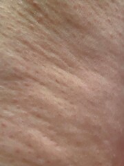 Fototapeta premium cellulite texture skin background surface with cellulite skin showing lumps and bumps