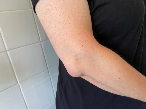 olecranon bursitis is sometimes called &ldquo;Popeye&rsquo;s elbow.&rdquo; Bursitis is a swelling of the bursitis sac here on elbow also known as tennis elbow