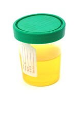 Urine sample in a clinical specimen container