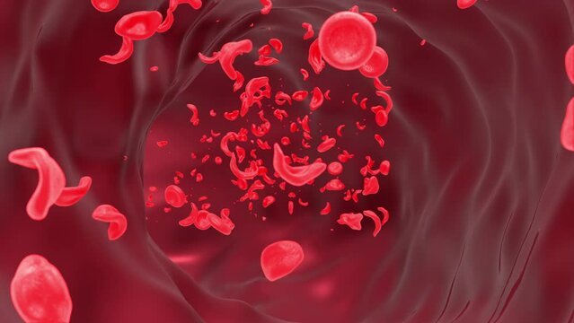 Sickle Cell Anemia In Blood Vessel