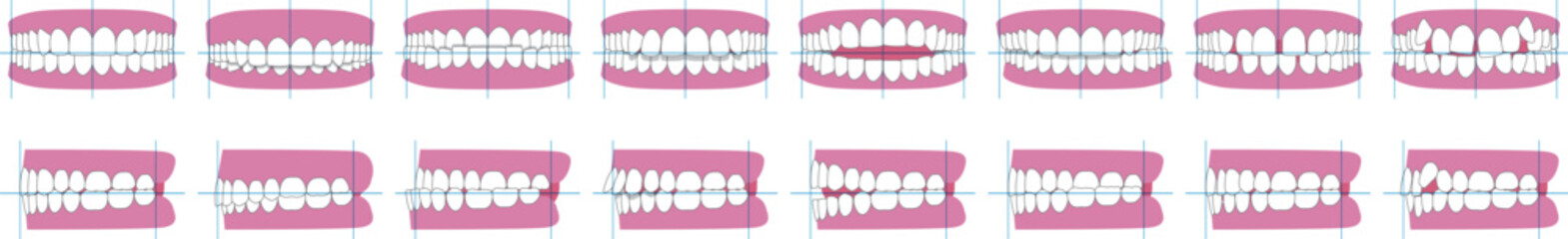 歯並び、歯列の不正咬合の種類。正面と横のベクターイラスト