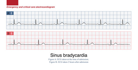 A 67-year-old man presents with heart palpitations, numbness of the lips and nausea after consuming poisonous shellfish. ECG showed sinus bradycardia.