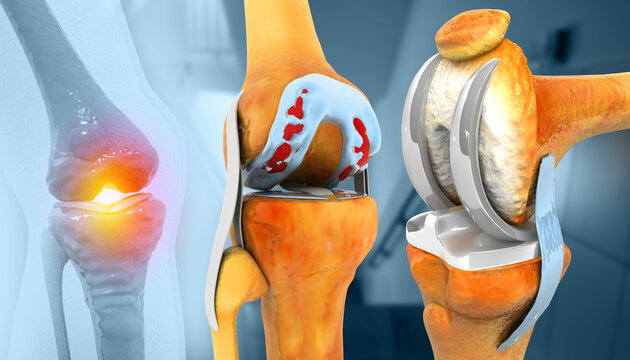 Knee Joint Replacement Surgery. 3d illustration
