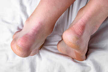 Dry skin on heel is cracked.  Dehydrated skin on heels of female feet.