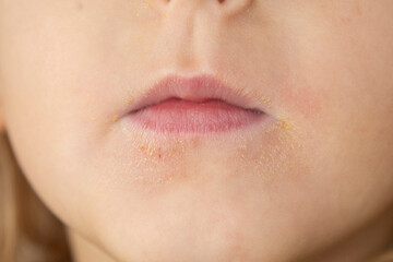 Little boy with dry skin on face, closeup - 703006685