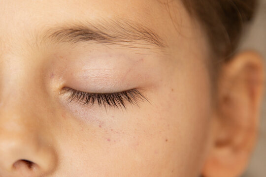 Little child with small red dots or petechia on the face under the eyes