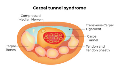 Carpal Tunnel Syndrome Science Design Vector Illustration Diagram