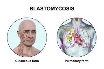 Clinical forms of blastomycosis, 3D illustration
