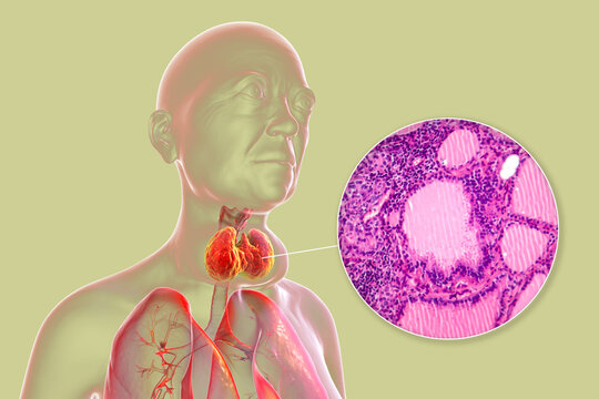 Toxic goiter, 3D illustration and micrograph