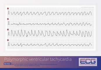 Male, 84 years old, admitted to hospital with chest pain for 1 day. ECG showed acute inferior and posterior MI and possibly right MI. The patient died of ventricular fibrillation the next day. - obrazy, fototapety, plakaty