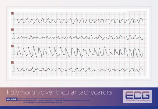 Male, 84 years old, admitted to hospital with chest pain for 1 day. ECG showed acute inferior and posterior MI and possibly right MI. The patient died of ventricular fibrillation the next day.