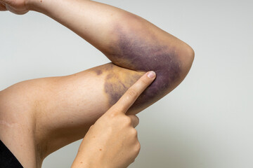 Finger on a large bruise. - obrazy, fototapety, plakaty