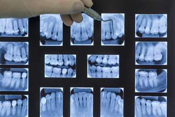 dentist doctor, oral x-ray examinations (oral x-ray). close up